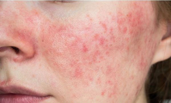 Skjule rosacea med sminke: Få det feilfrie utseendet tilbake